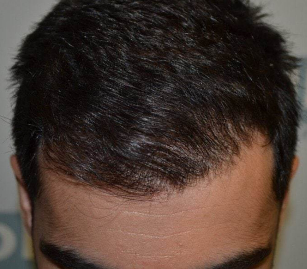 Dhi пересадка волос. Метод пересадки волос DHI.