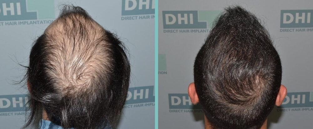 Hair Transplant Before After Photos | DHI Vienna
