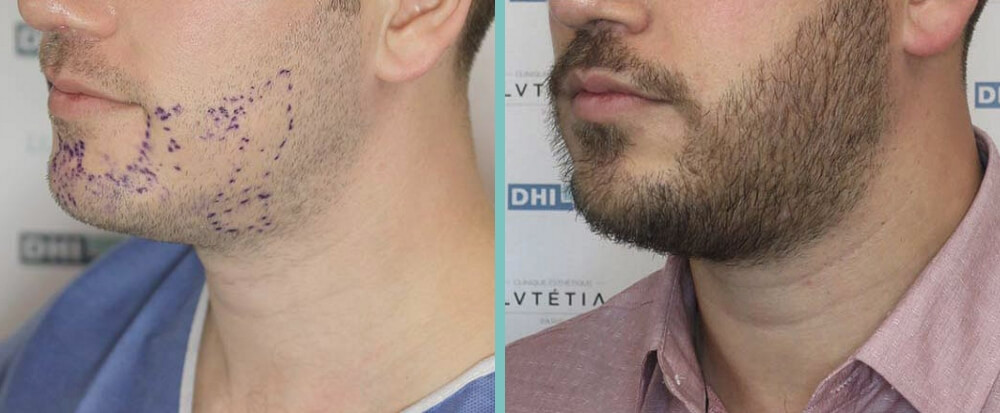 Bild zeigt Barttransplantation