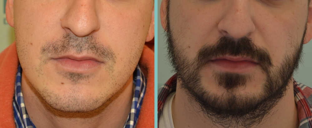 Bild zeigt Vorher Nachher Bild Barttransplantation