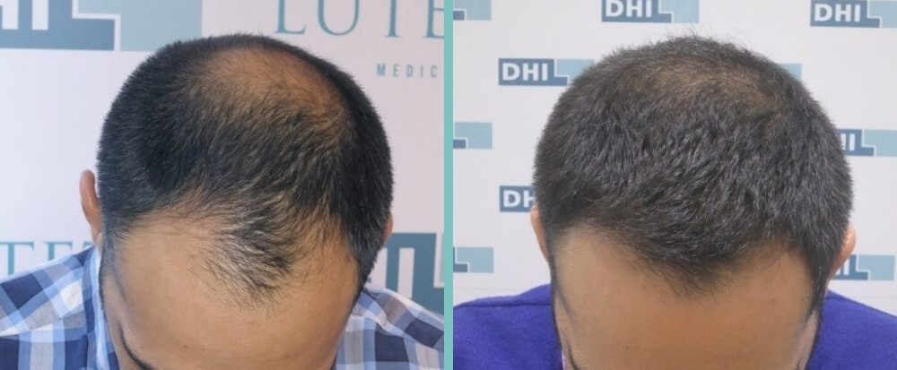 Hair Transplant Before After Photos | DHI Vienna