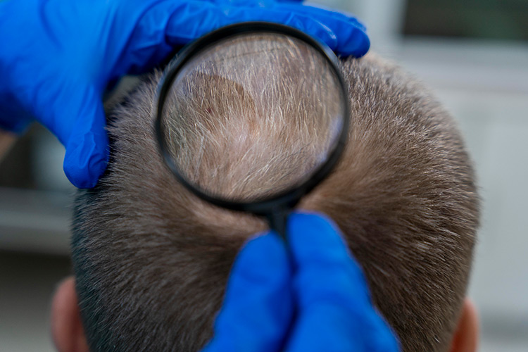 Bild zeigt Lupe auf Haaransatz