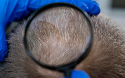 Geschichte der Haartransplantation