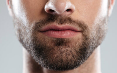 Barttransplantation in Wien: für einen vollen, dichten Bart