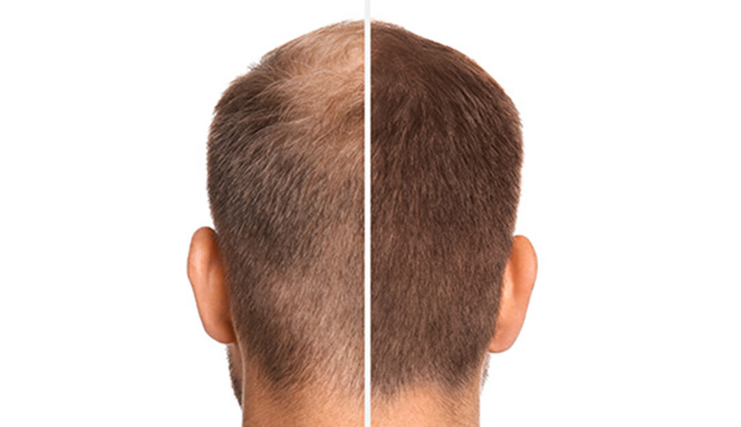 Prominente mit Haartransplantationen