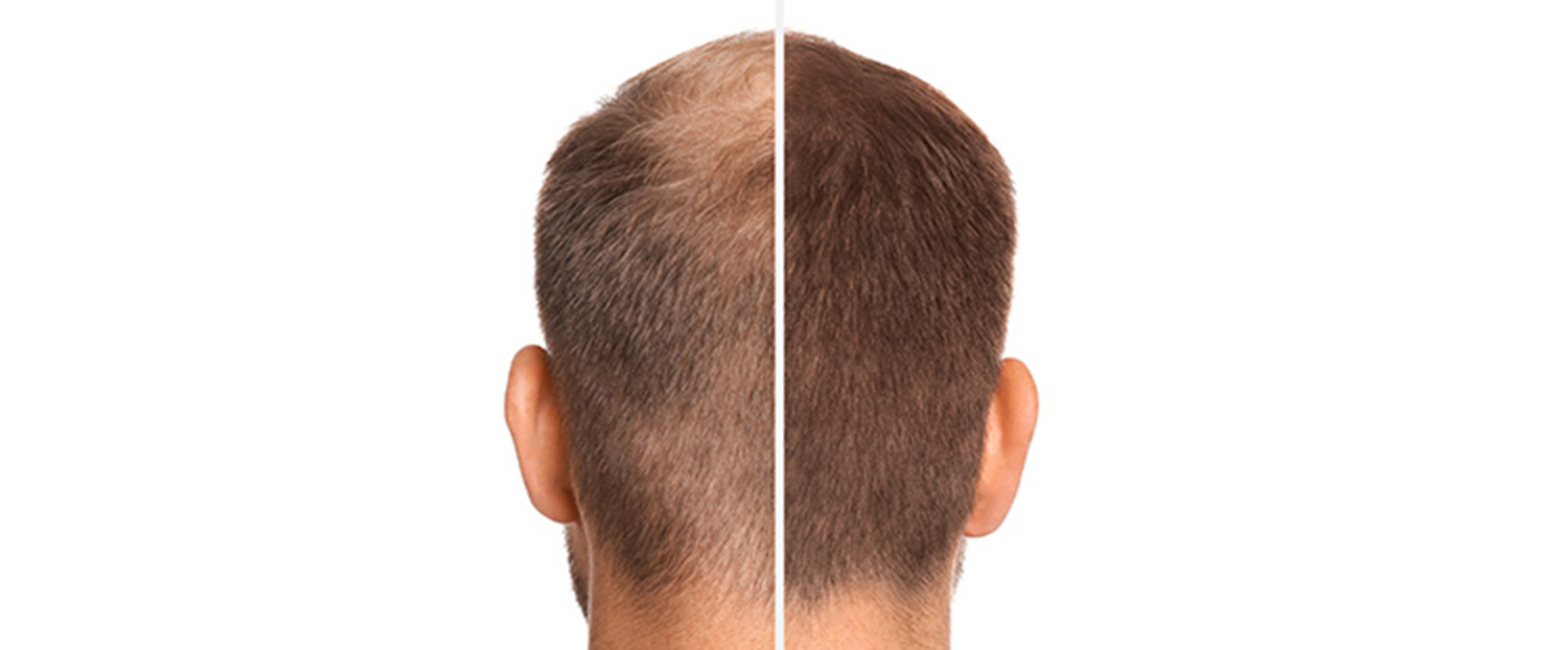 Bild zeigt Mann vor und nach Haartransplantation