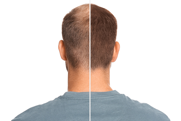 Bild zeigt Mann vor und nach Haartransplantation