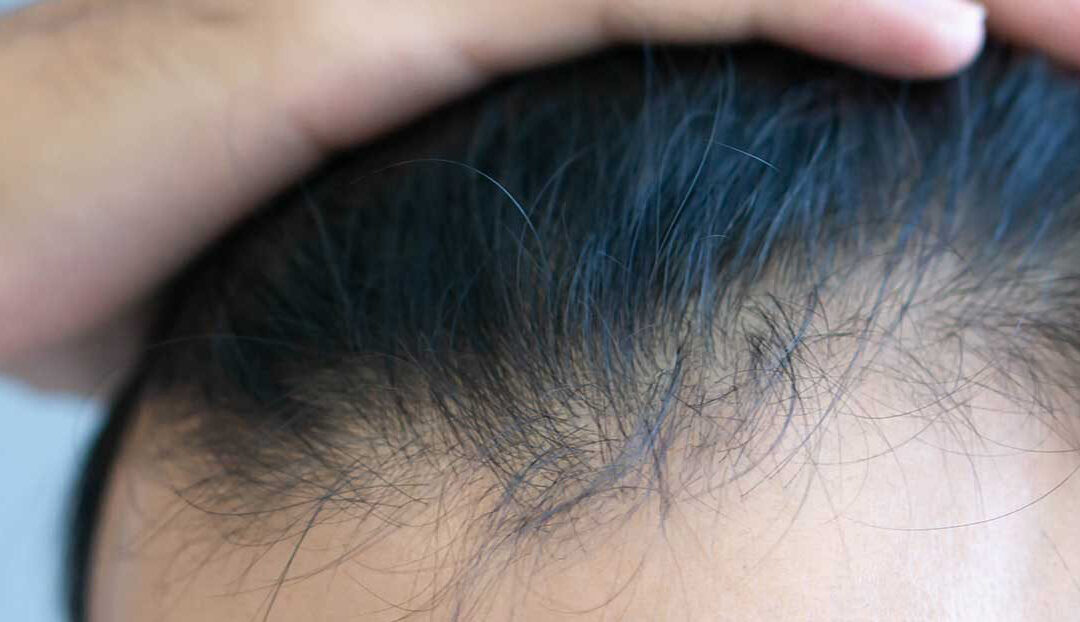 Unshaven – Haarverpflanzung ohne Rasur