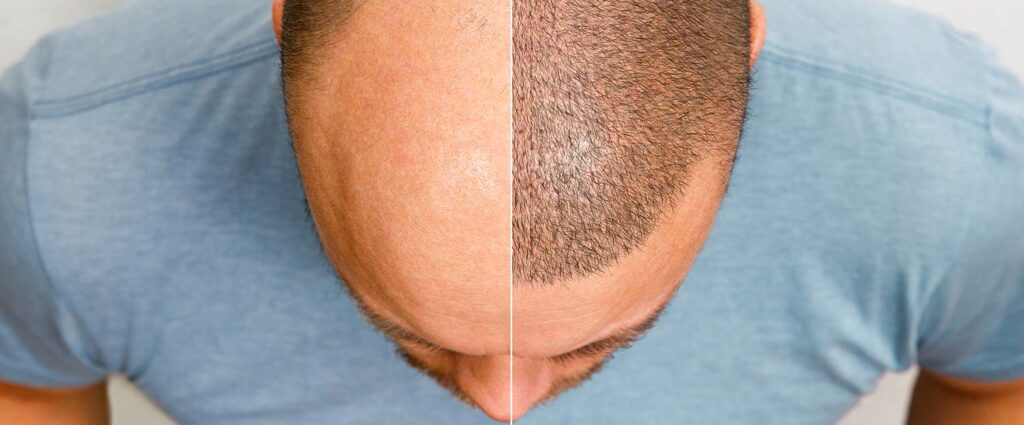 Haarverpflanzungen steigern das Wohlbefinden