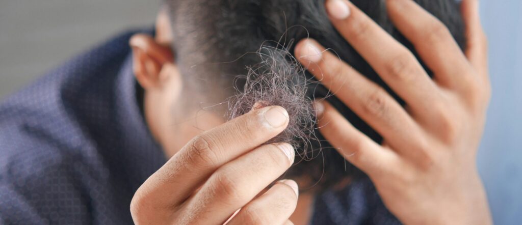 Haartransplantation: Wie lange hält das Ergebnis wirklich?