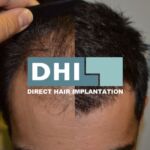 DHI - Haartransplantation